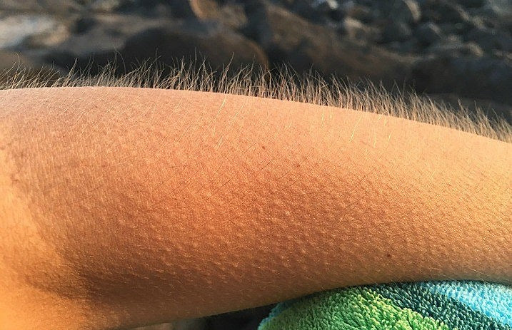 goosebumps